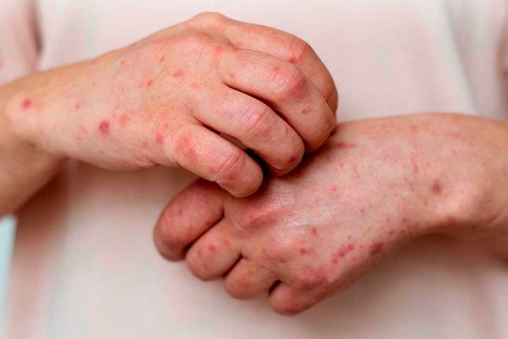 La viruela símica llevó a reforzar el monitoreo de Salud en el Chaco